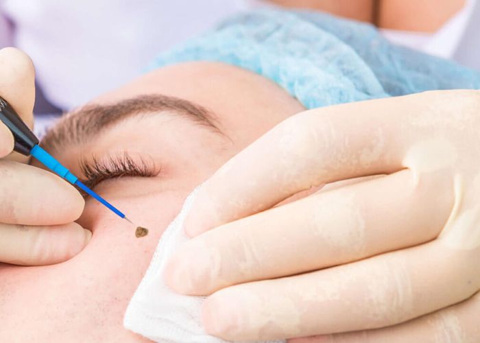 Electrosurgery & Radiofrequency Procedures