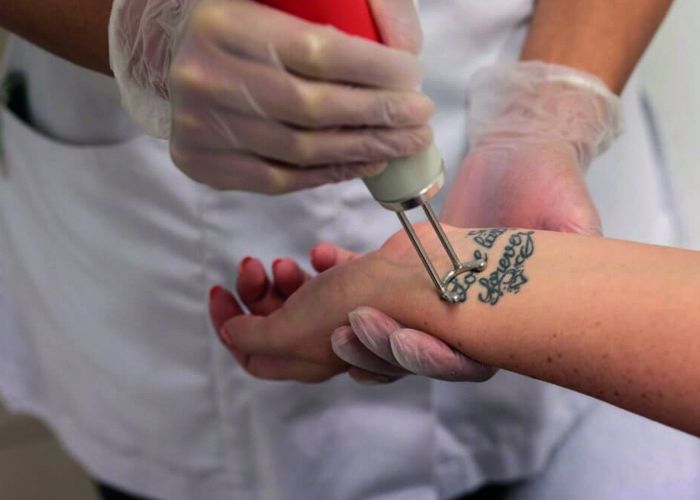 Tattoo Removal Treatment | Radium Medical Aesthetics Singapore