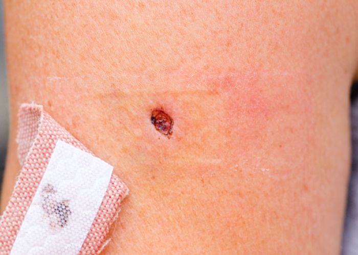 Skin biopsy